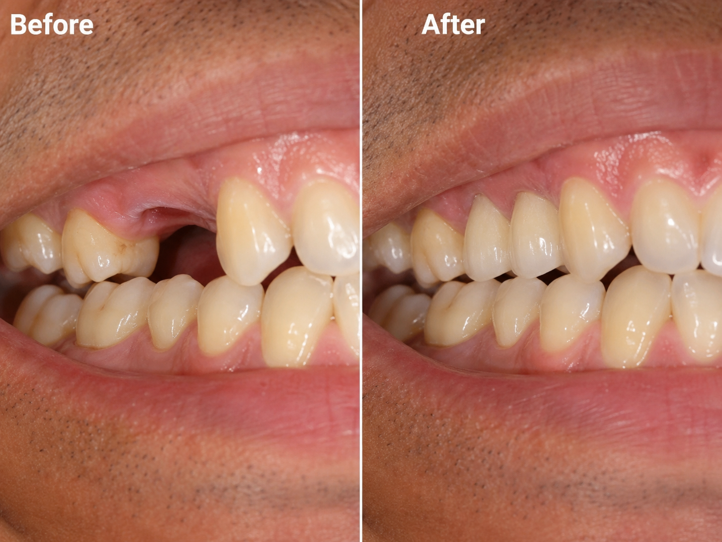 Before and after: Bridge / Missing Tooth